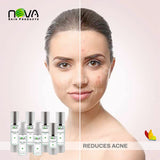 Acne Kit 7 Products By Nova Skin