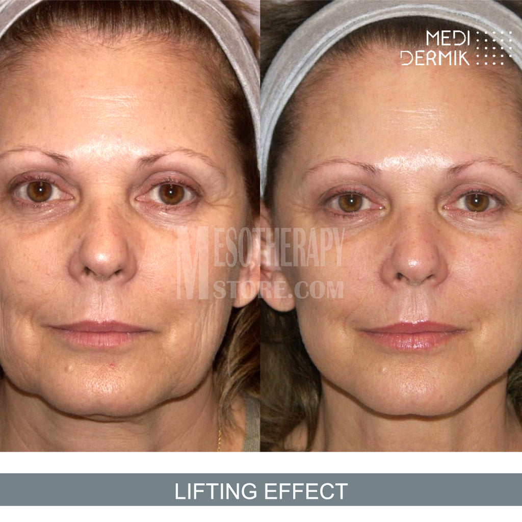 DMAE System By Medidermik Mesotherapy - Mesoterapia